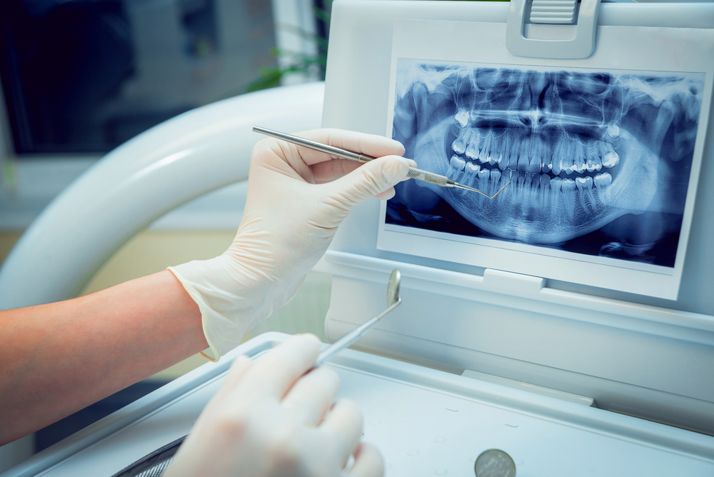 implantes dentales druiz