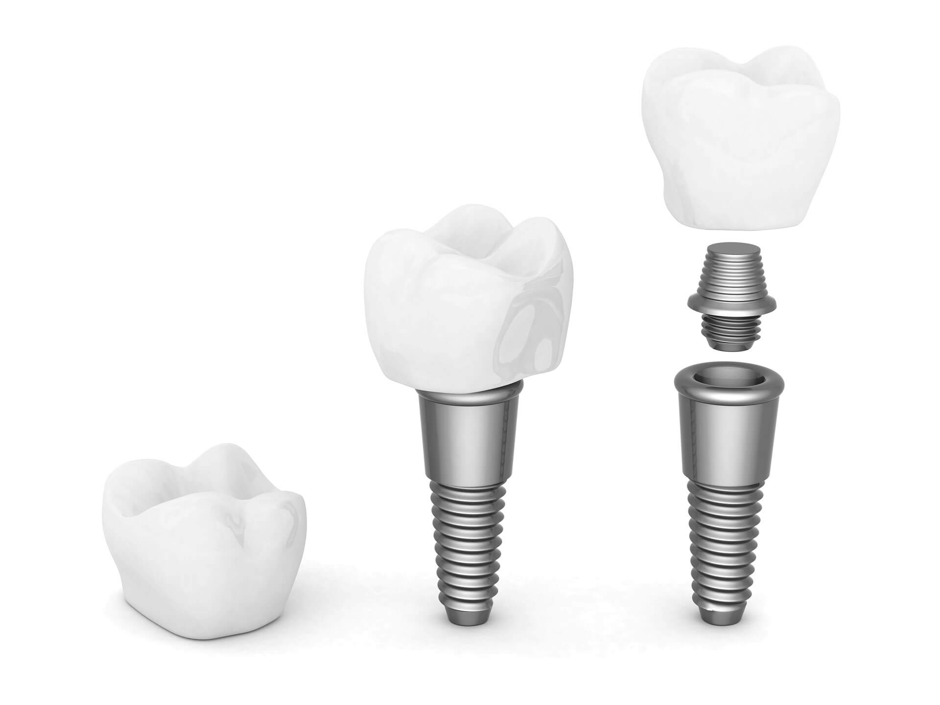 implantes-dentales-burgos