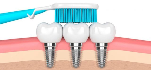 como-cuidar-implantes-dentales