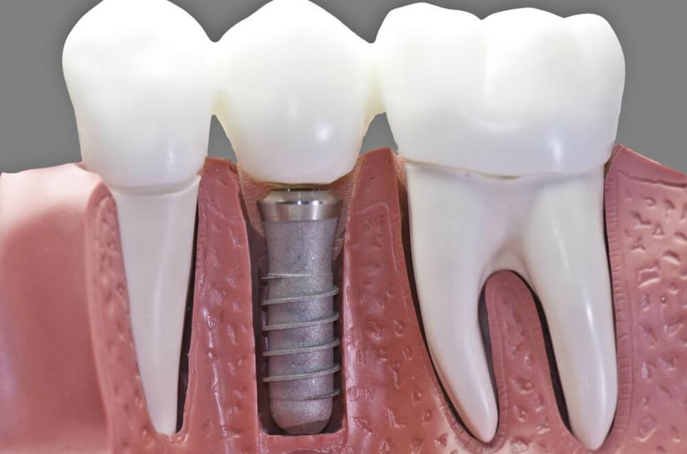 cuidados-tras-tratamiento-implantes-dentales
