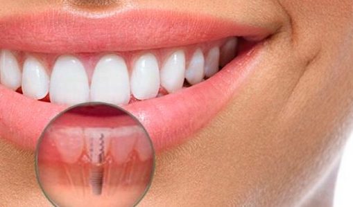 implantes-de-carga-inmediata-clinica-dental-burgos
