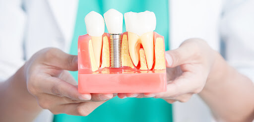 cuidar-implantes-dentales