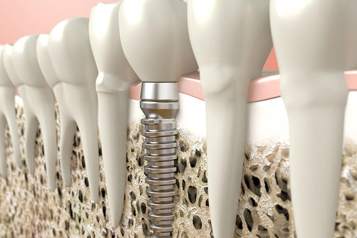 osteointegracion-implantes-dentales-burgos