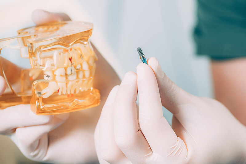 osteointegracion-implantes-dentales-burgos
