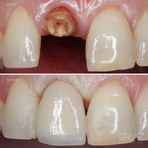 antes-despues-implantes-dentales-burgos